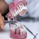 Why Dental Implants Newcastle Are the Best Long-Term Choice