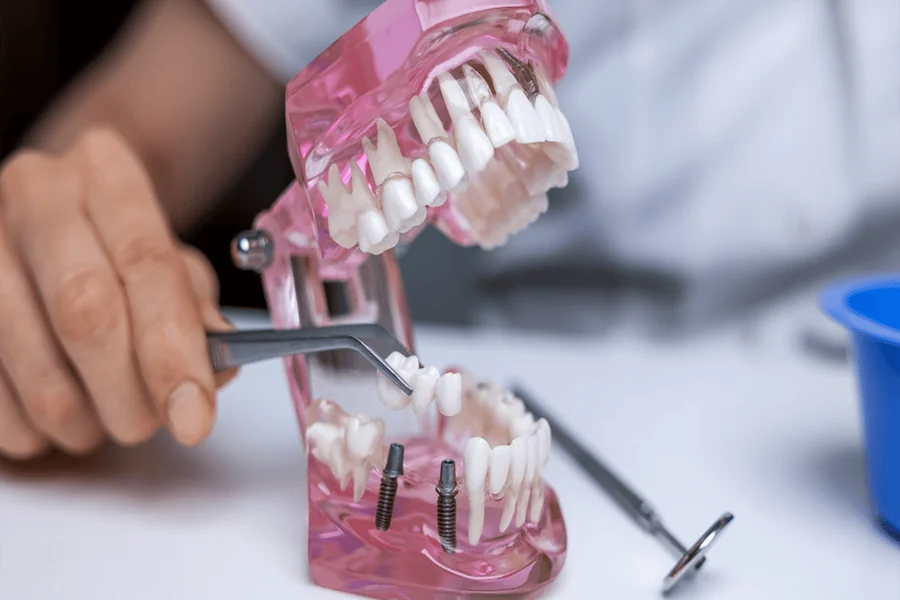 Why Dental Implants Newcastle Are the Best Long-Term Choice