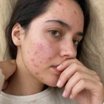 Acne Spot Corrector: Stop Blemish Redness and Inflammation 
