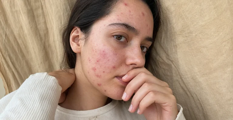 Acne Spot Corrector: Stop Blemish Redness and Inflammation 