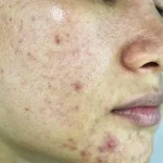 Acne Spot Corrector: Stop Blemish Redness and Inflammation 